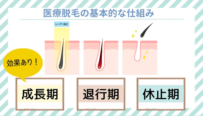 医療脱毛の基本的な仕組み