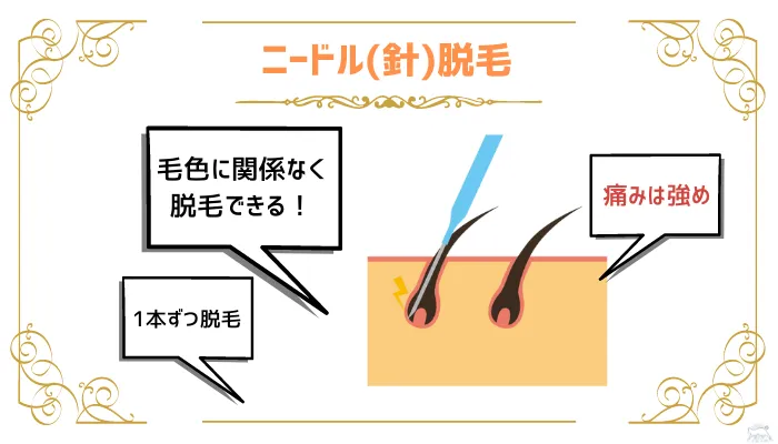 永久脱毛ニードル脱毛