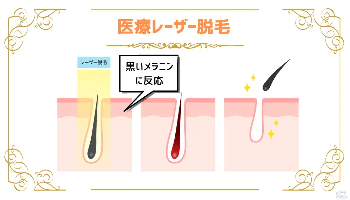 永久脱毛医療レーザー脱毛